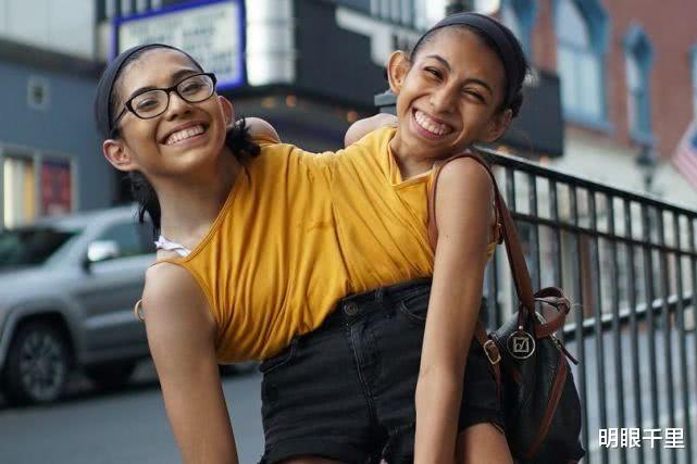 曾被诊断只能活3天的美国连体双胞胎长到19岁各自控制一条腿