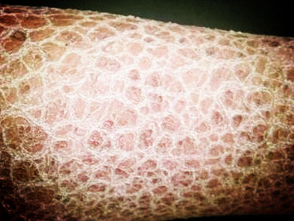 女子爱上吃蛇肉发现胳膊长出蛇皮诊断结果出来惊慌失措