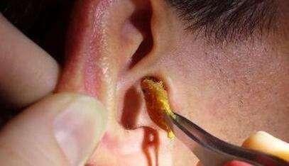 关于强迫症鸡皮疙瘩的信息 关于强迫症鸡皮疙瘩的信息