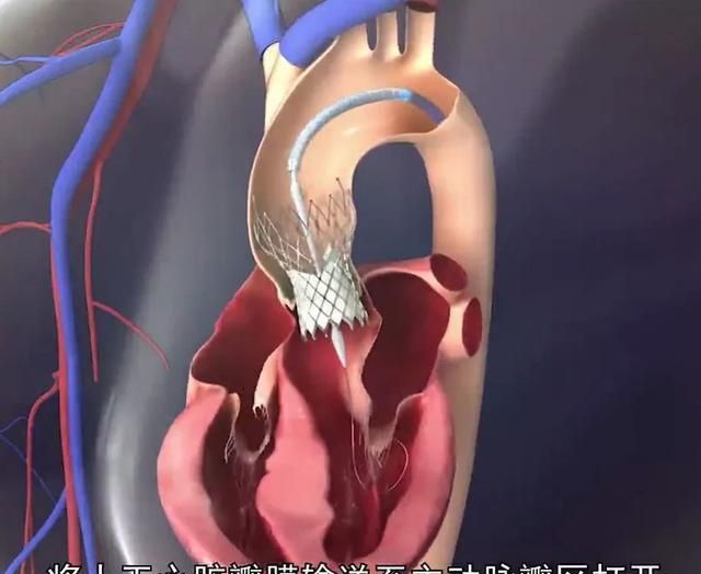 仅用30分钟,王建安教授团队让78岁老人焕新生|主动脉瓣狭窄|王建安