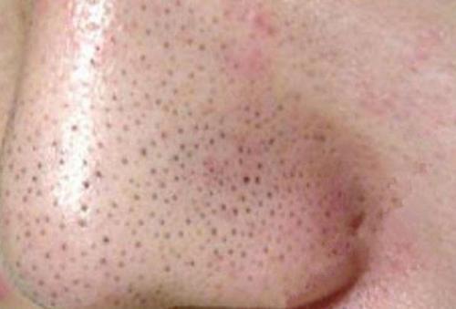 要注意什么?|黑头|毛孔|皮肤_新浪新闻