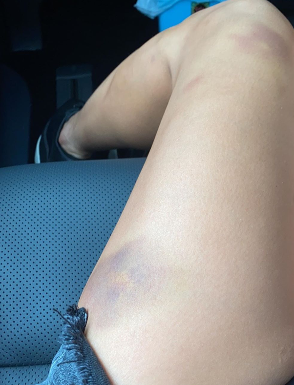 洗米嫂晒图大腿多处瘀伤,网友质疑:洗米华家暴?