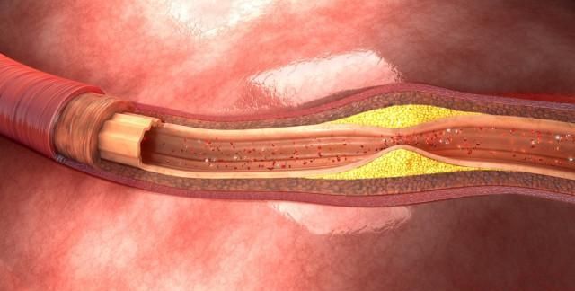 "死胖子"们居住在血管内皮中,会刺激血管组织增生,把它们包裹起来.