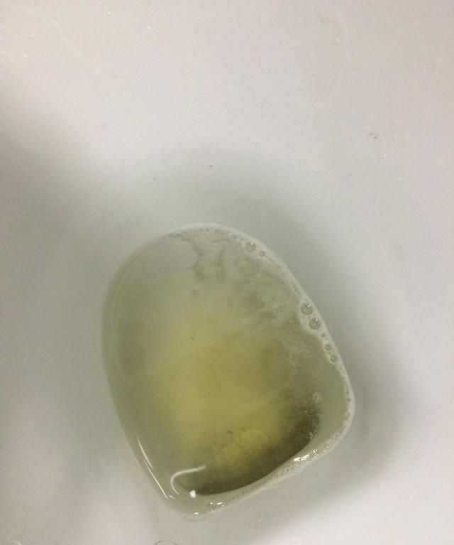尿酸高会让马桶变黄吗如果不会尿液使马桶变黄的原因是什么