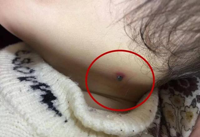 女儿身上多出"一颗痣",父母看后送去检查,医生:还好发现及时