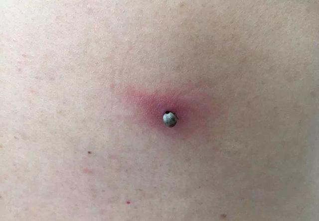 父母看后送去检查,医生:还好发现及时|蜱虫|宿主|黑痣_新浪新闻