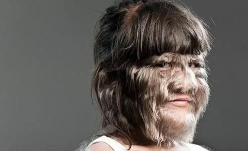 世界上"体毛"最多的女孩 当剔除全身毛发后 不敢相信自己的眼睛