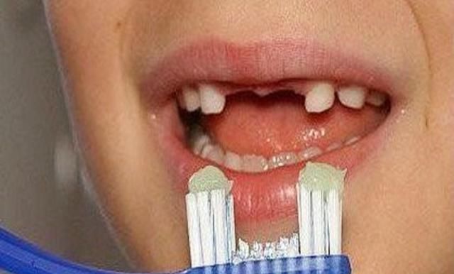 孩子"满口黑牙"的原因不是糖果,幕后元凶被很多妈妈忽略了|牙齿|黑牙