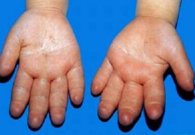 7个月的宝宝全身水肿呕吐不止检查后医生直言喝水喝的