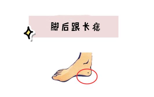 身体5颗"倒霉"痣,人缘差招人嫌,生活贫困,晚年没有落脚处!