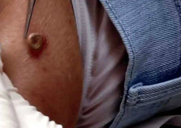 女子身上突然长出肉瘤,医生检查才知不是肉瘤,取出后仍十分后怕