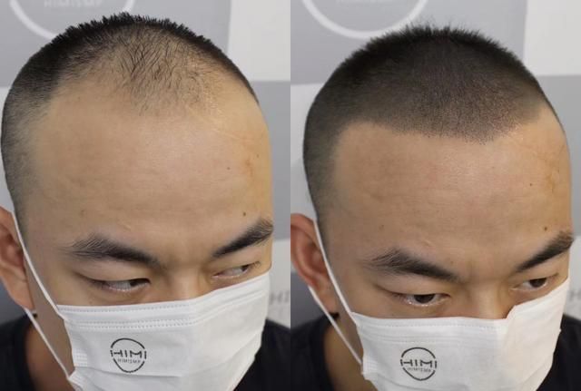 脱发治不好，剃光头就可以了？太天真了！|脱发|剃光头|毛囊_新浪新闻