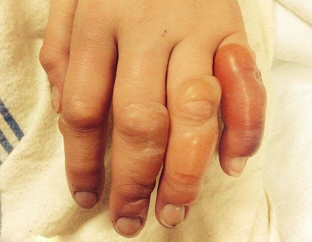 女子晚上醉酒露宿街头,第二天醒来后,让她傻了眼|水泡|手指|疮痂_新浪