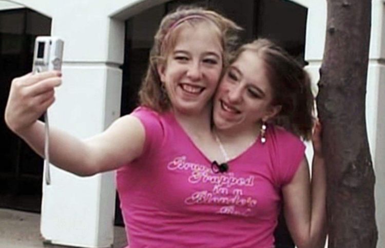 世界上真实存在的"双头人",姐妹共用一个身体,却爱上不同男人