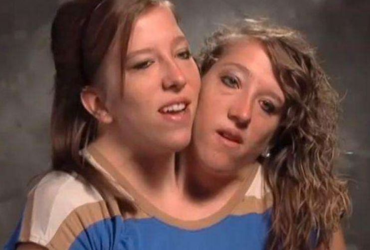 世界上真实存在的"双头人",姐妹共用一个身体,却爱上不同男人