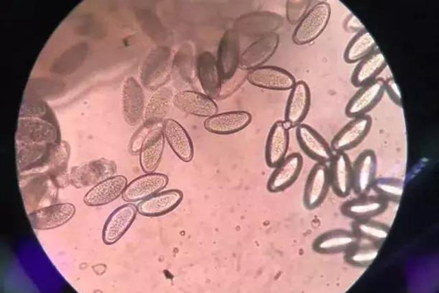 4岁宝宝晚上哭闹说"屁屁痒",家长脱下裤子一看,什么东西在动|蛲虫