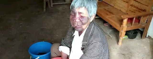 南充农村68岁老人满脸长满血管瘤,眼睛也瞎了40年,可怜!