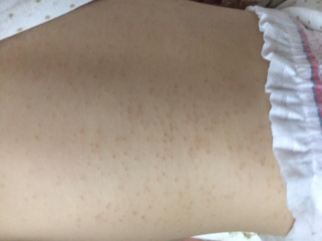 宝宝长出湿疹,怎么护理恢复快?新手父母看看