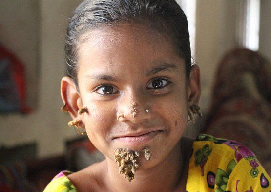 小女孩嘴角长满树枝,看后吓一跳,同学们却还愿意和她成为朋友