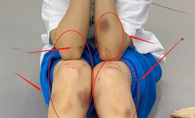 海涛为女友庆生晒照,看到沈梦辰练舞留下的淤青,太心疼了休闲区蓝鸢梦想 - Www.slyday.coM 海涛为女友庆生晒照,看到沈梦辰练舞留下的淤青,太心疼了休闲区蓝鸢梦想 - Www.slyday.coM