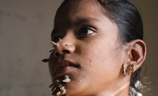 小女孩嘴角长满树枝,看后吓一跳,同学们却还愿意和她成为朋友