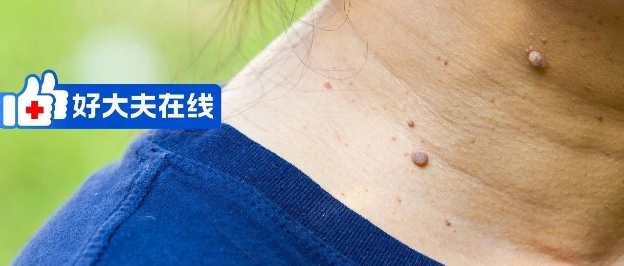 身上的瘊子竟和HPV感染有关,会越挠越多!|HPV|病毒感染_新浪新闻