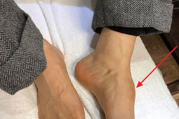 魔女的时候,为了吊威亚从两层楼高的地方摔下来,导致脚趾骨粉碎性骨折