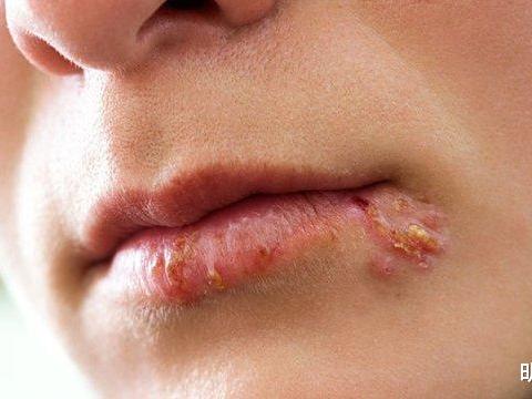 英国健身教练约会亲吻女网友后患上唇疱疹,起诉对方索赔116万元