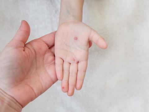 提醒:容易复发|汗疱疹|水泡|体质_新浪新闻