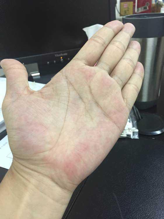 信号三:手掌变化情况严重者,还会出现脂肪肝,并且伴有浮肿的现象.