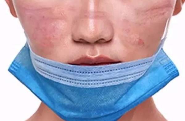 戴口罩引起的皮肤过敏发红发痒起小疹子该怎么缓解