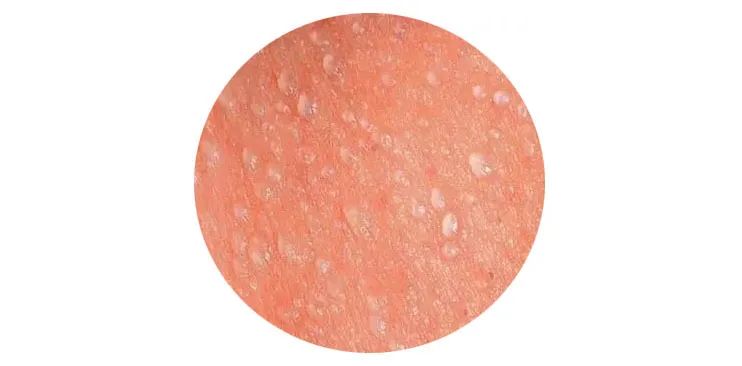 晶痱痱子根据严重程度,分为晶痱,红痱和脓痱三种常见的形态.