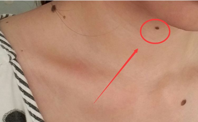 这几个位置长吉痣财不露白低调富豪这个位置是凶痣