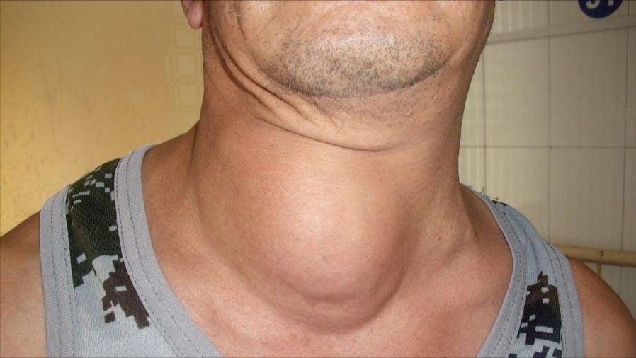 大脖子病初期症状图片图片