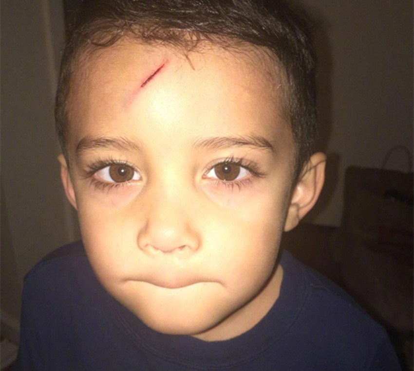 萌娃不小心撞破额头,机智妈妈让娃秒变"哈利波特",网友:厉害