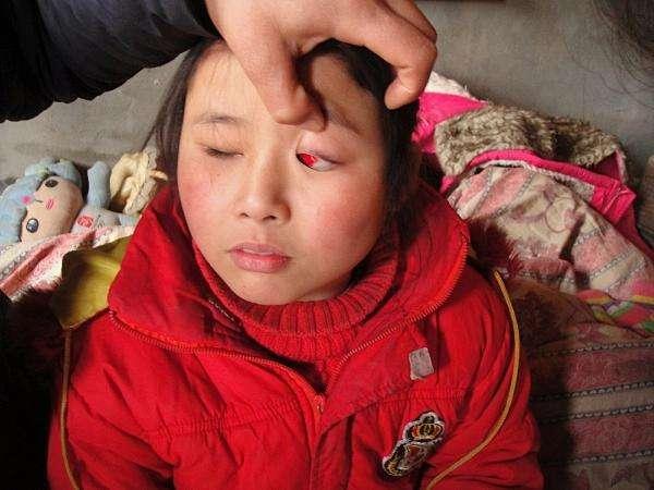 全球18万血友病患儿,巨大经济压力后的教育压力,绝不该被忽视