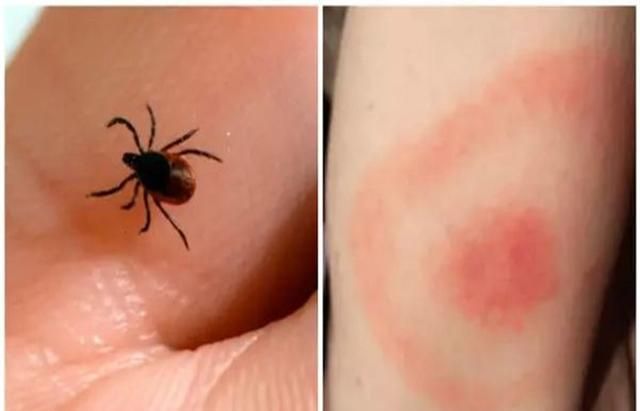 加拿大曾出现罕见蜱虫如果被叮咬可能再也无法吃肉