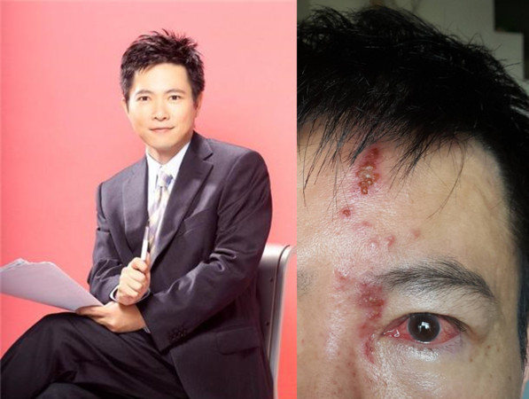 知名前主播免疫系统失调致半脸全毁险失明退圈旅游被传感染病毒