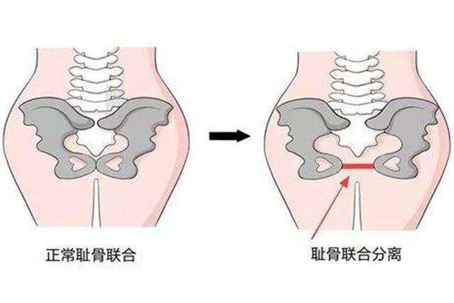 3)胎儿入盆临近预产期时,胎儿头的位置逐渐向下移,会压迫到孕妇的骨盆