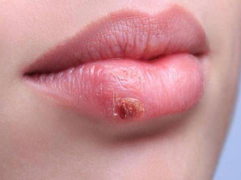 唇炎的病因离不开这5种 4个小妙招 早知道早好