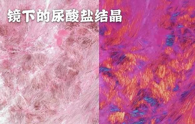 医生辟谣给您说清楚|辟谣|痛风|尿酸_新浪新闻