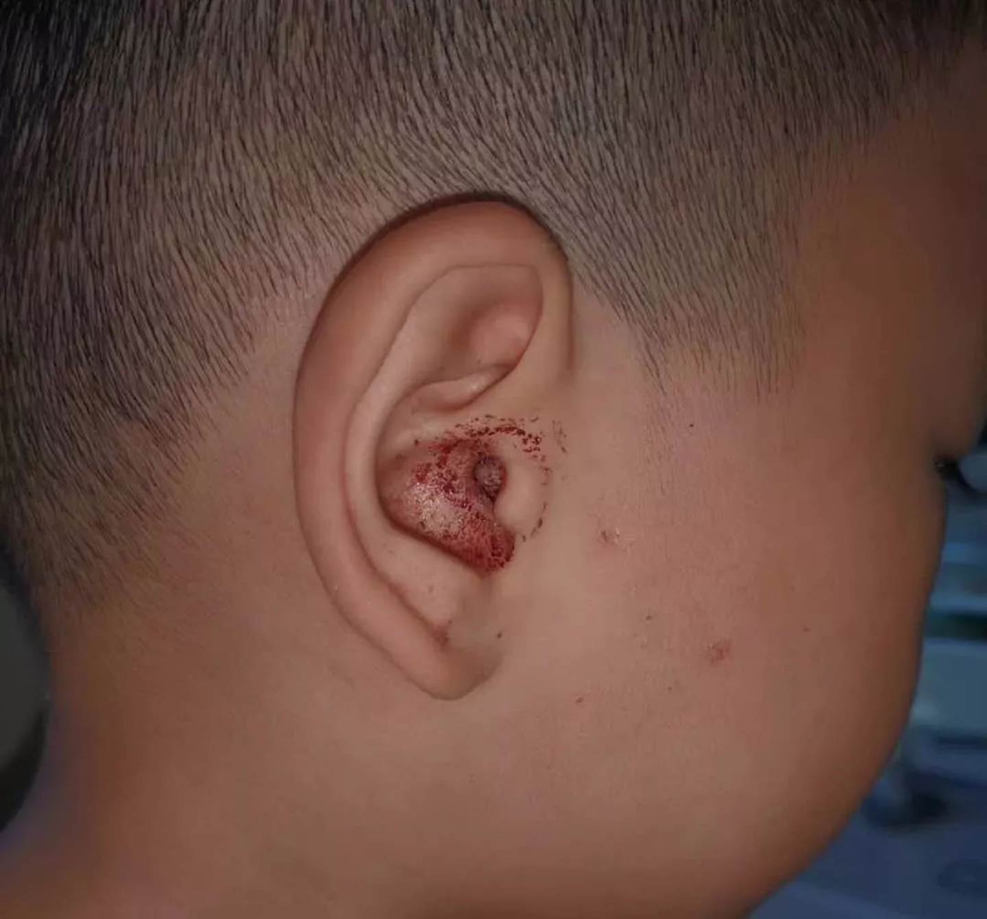 孩子总喊耳朵痒疼,原以为是中耳炎,医院检查时医生都吓到了