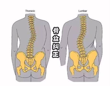 期待已久的骨盆矫正—全方位改善骨盆前倾