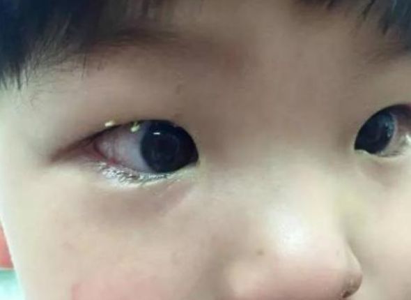 5岁宝宝眼睛突然看不见了,家人以为是上火,检查后医生:来晚了