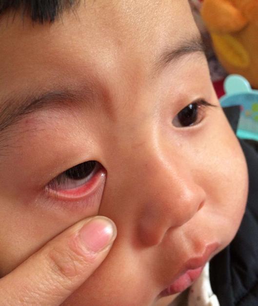 宝宝白眼球有黑斑图片