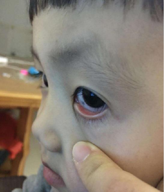 孩子眼睛里的眼白有"黑点"?爸妈不用惊慌,这3原因惹得"祸"