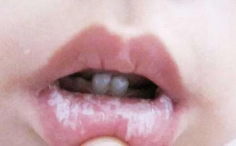 疱疹性咽峡炎又到高发期别与手足口病口腔溃疡搞混了
