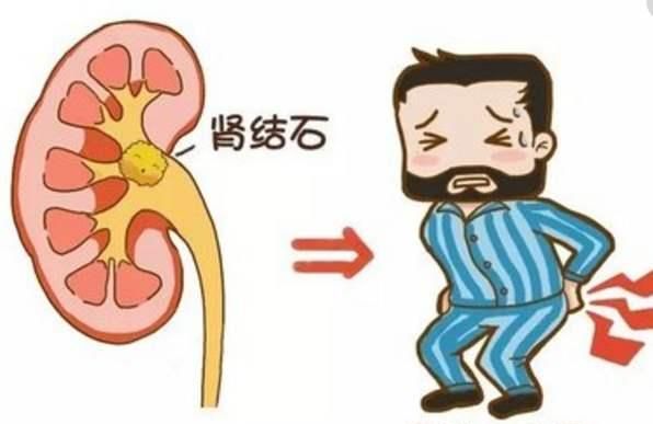 得了肾结石,多喝水就可以?不如先了解这些事