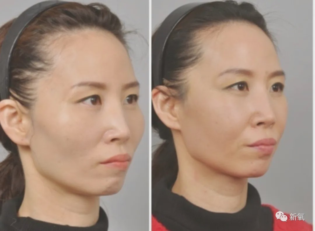不过据羊所值,眼眶骨手术目前国内应该没有医生在做~(如果有,请原谅