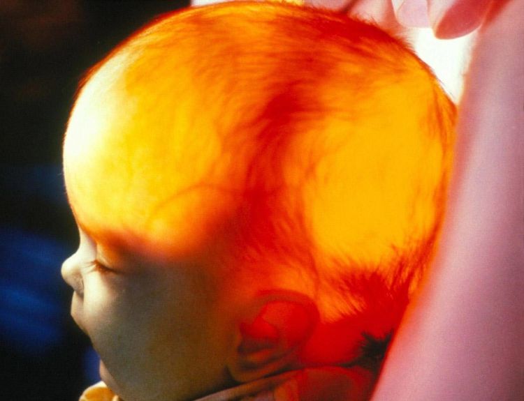 宝宝头越大越聪明吗?聪不聪明还不知道,可能有病倒是真的